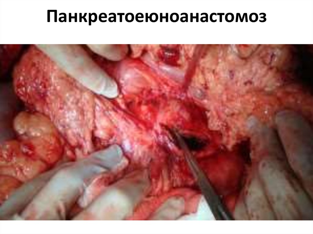 Панкреатоеюноанастомоз