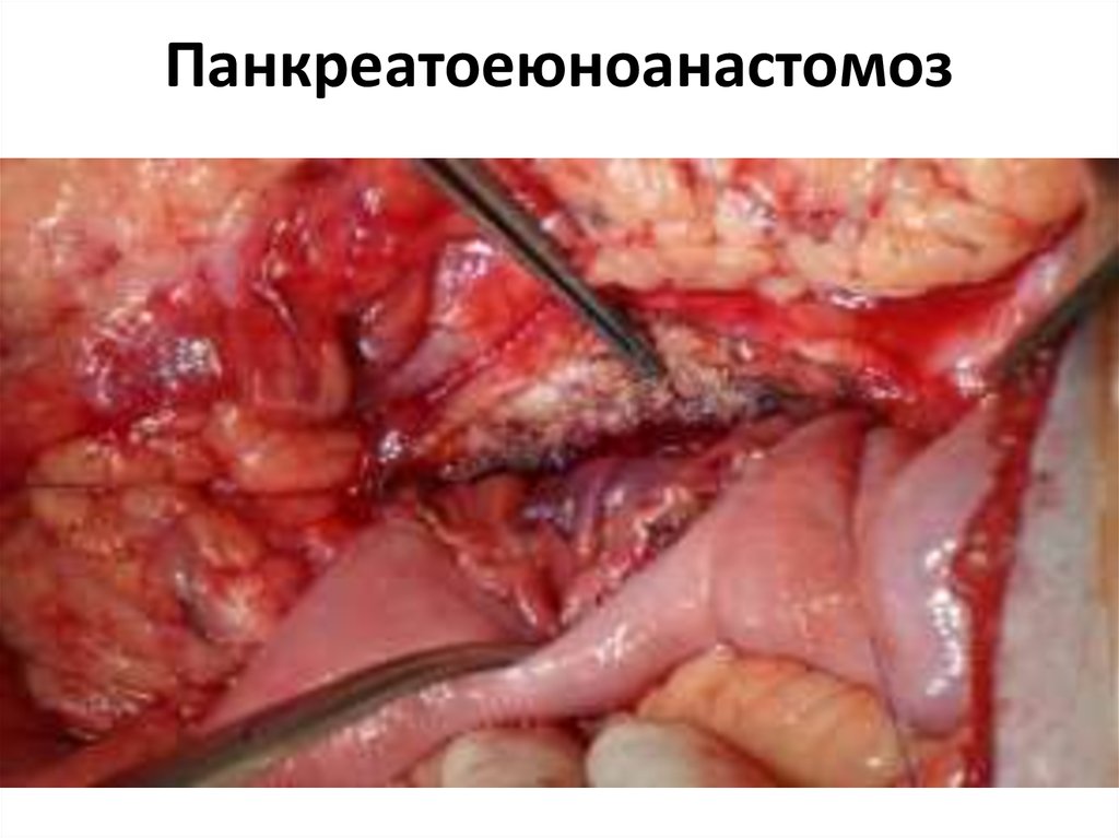 Панкреатоеюноанастомоз