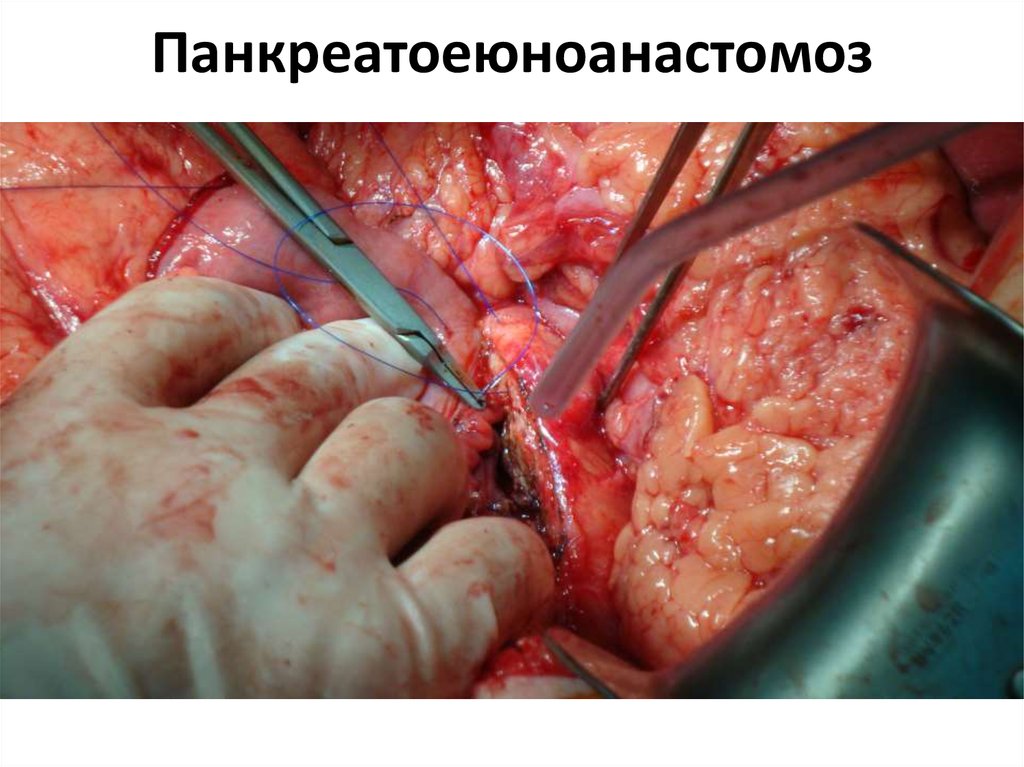 Панкреатоеюноанастомоз