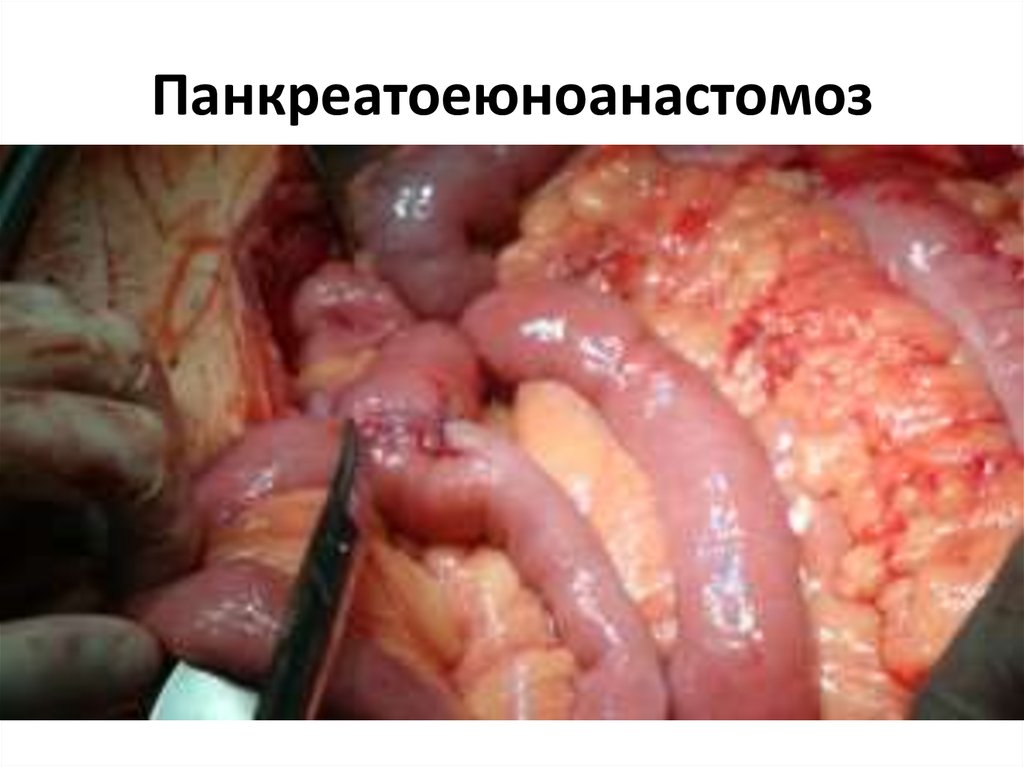 Панкреатоеюноанастомоз