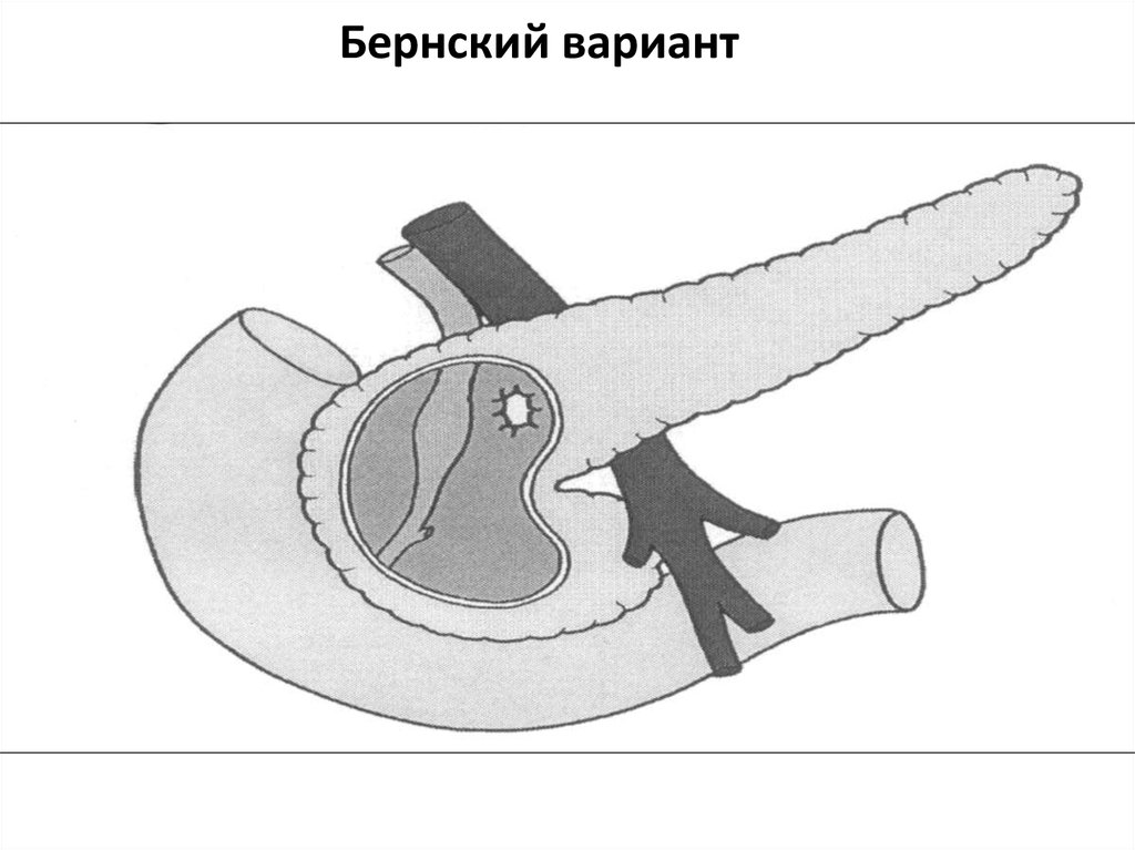 Операция фрея на поджелудочной железе схема