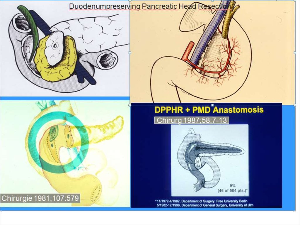 Операция фрея на поджелудочной железе схема