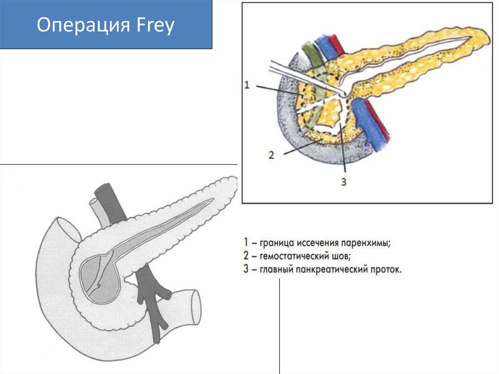 Резекция поджелудочной железы схема