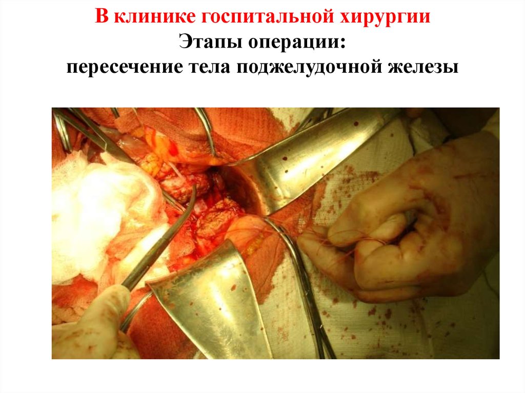 В клинике госпитальной хирургии Этапы операции: пересечение тела поджелудочной железы