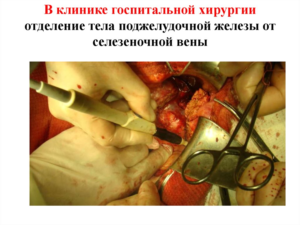 В клинике госпитальной хирургии отделение тела поджелудочной железы от селезеночной вены