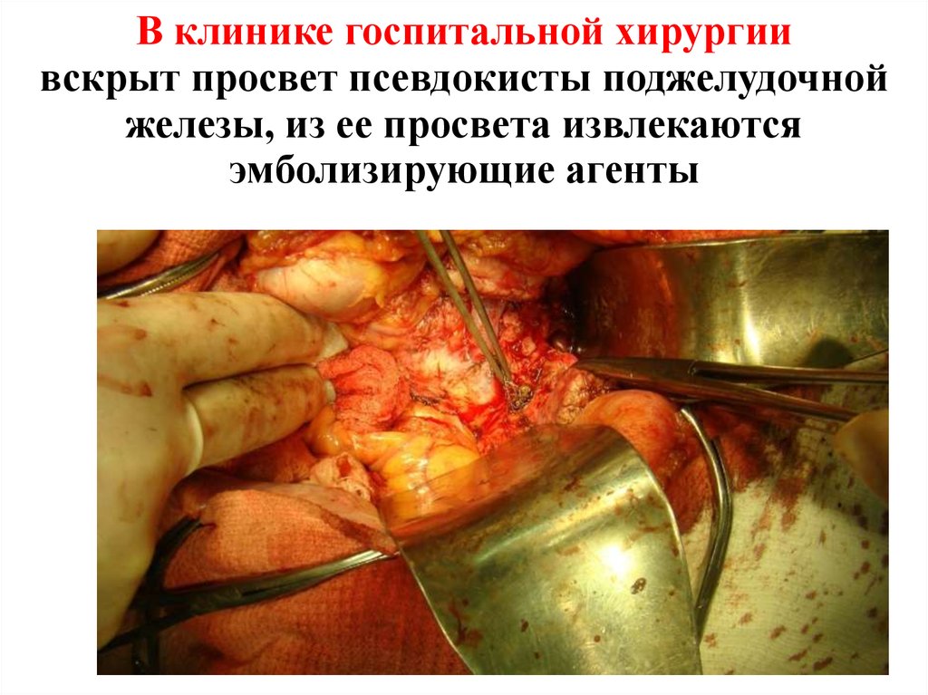 В клинике госпитальной хирургии вскрыт просвет псевдокисты поджелудочной железы, из ее просвета извлекаются эмболизирующие