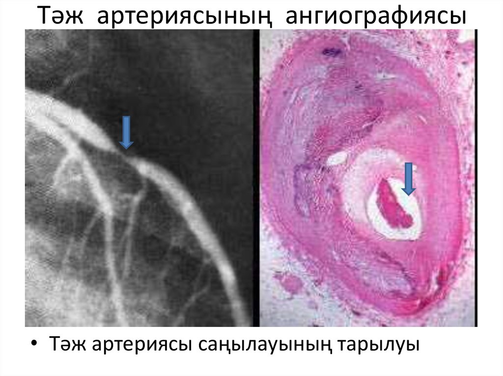 Тәж артериясының ангиографиясы