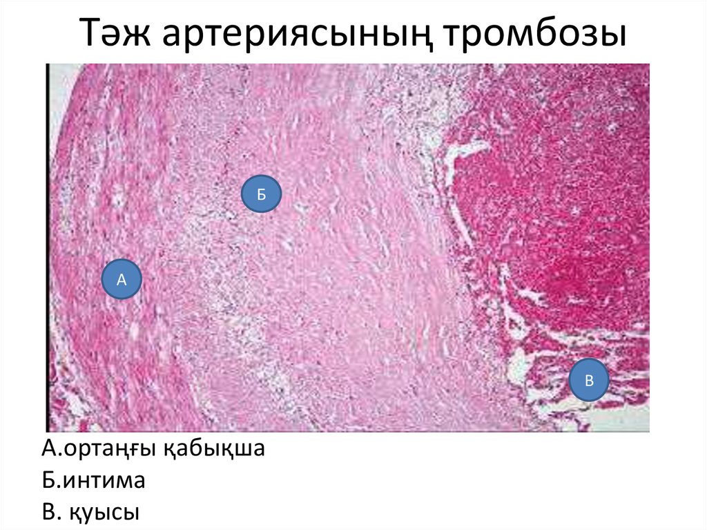 Тәж артериясының тромбозы