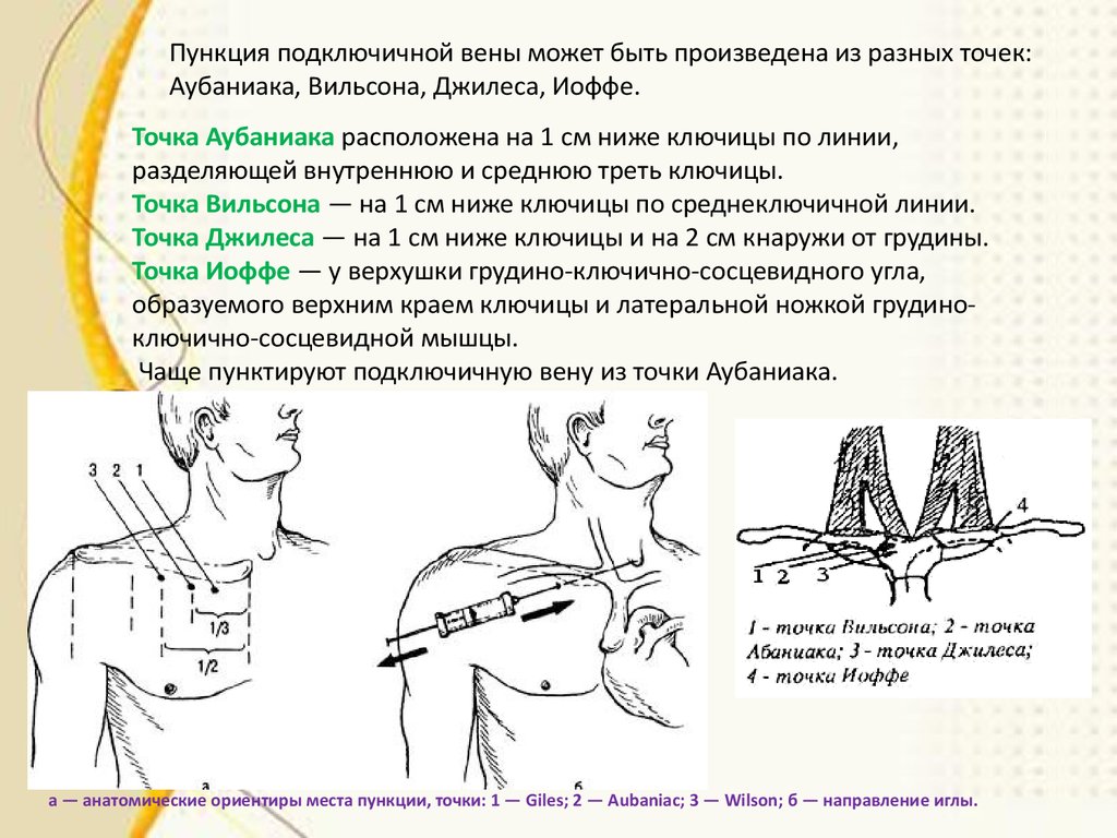 Схема по сельдингеру рентген