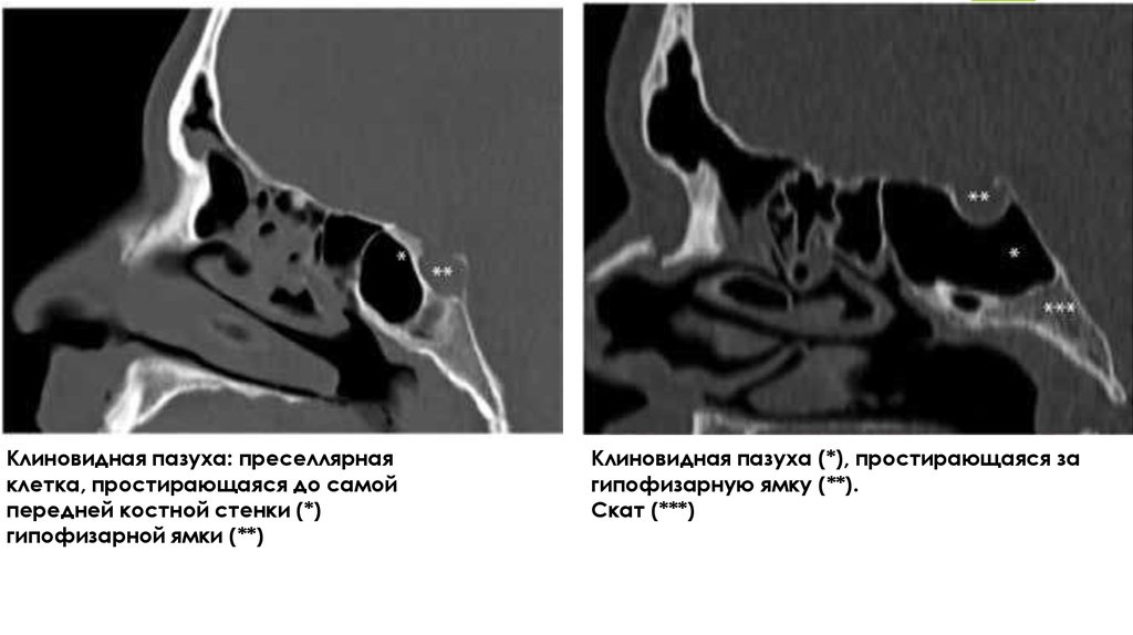 Где находится клиновидная пазуха фото носа