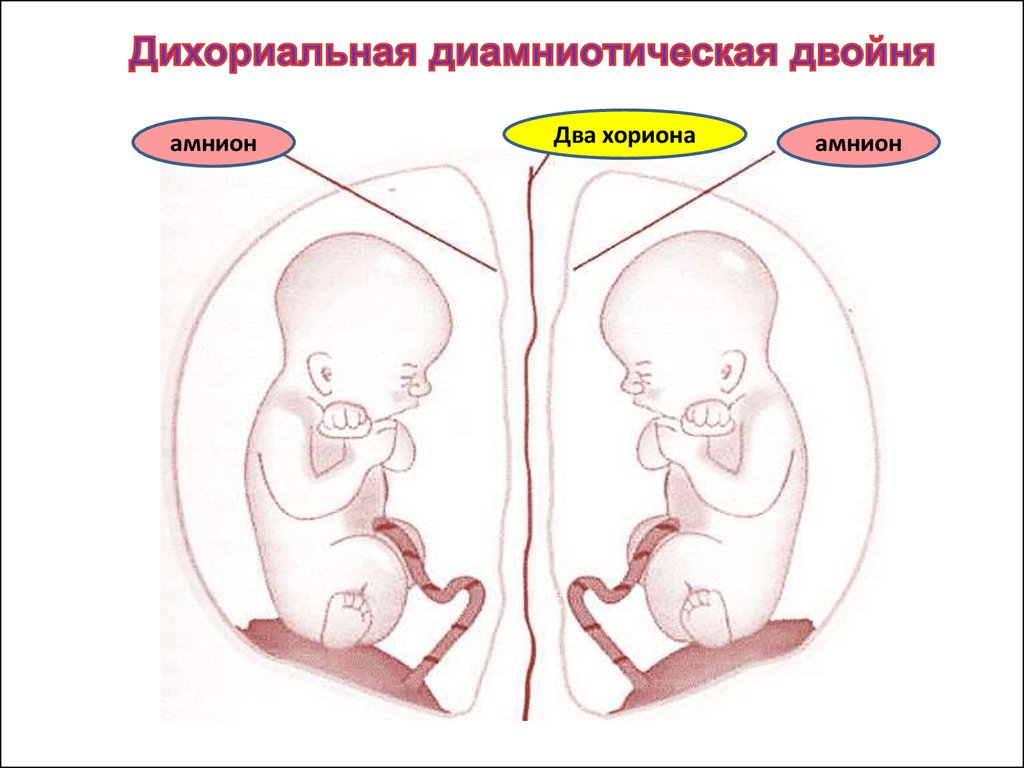 Монохориальная двойня. Дихориальная беременность двойней. Монохориальная моноамниотическая двойня. Монохориальная диамниотическая многоплодная беременность. Дихориальная диамниотическая двойня схема.