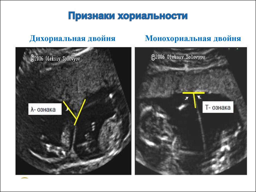 Монохориальная двойня. Монохориальная многоплодная беременность. Монохориальная двойня УЗИ. Монохориальная многоплодная беременность на УЗИ. Монохориальная двойня УЗИ 5 недель.