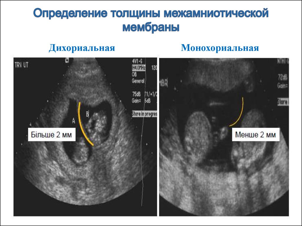 Монохориальная двойня. УЗИ признаки монохориальной двойни. УЗИ критерии многоплодной беременности. Дихориальная и монохориальная. Дихориальная диамниотическая двойня УЗИ.