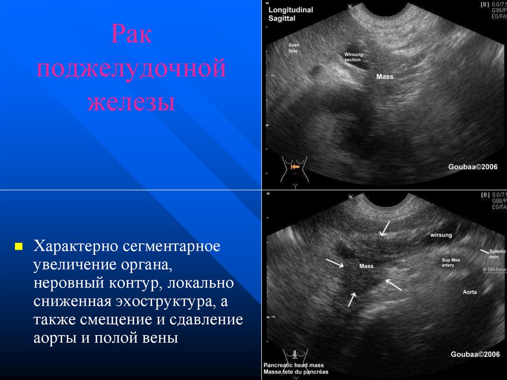 Увеличение органа. Неровные контуры поджелудочной это. Поджелудочная железа бугристые контуры что такое. Эхоструктура поджелудочной железы. Поджелудочная железа контуры неровные четкие.