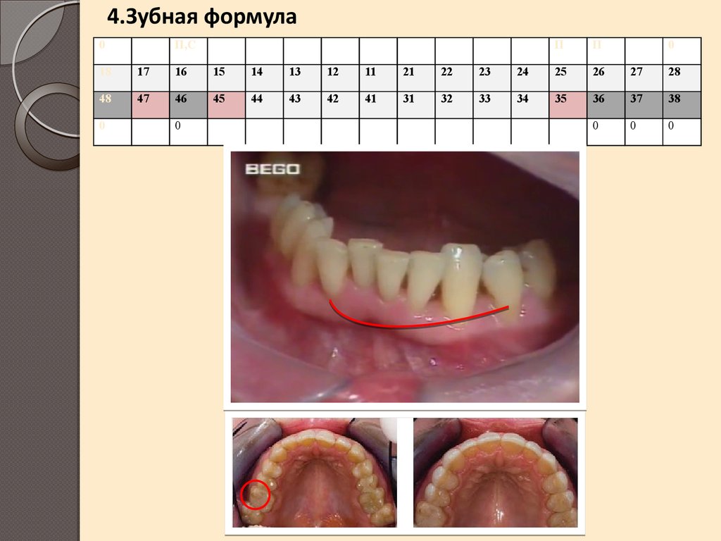 Реферат: История болезни - Стоматология (Перелом нижней челюсти в области 8)