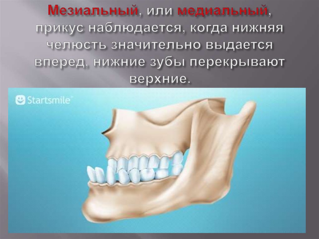 Лечение мезиальной окклюзии. Прикус зубов низняя челюсть вперёд. Прикус нижняя челюсть вперед.