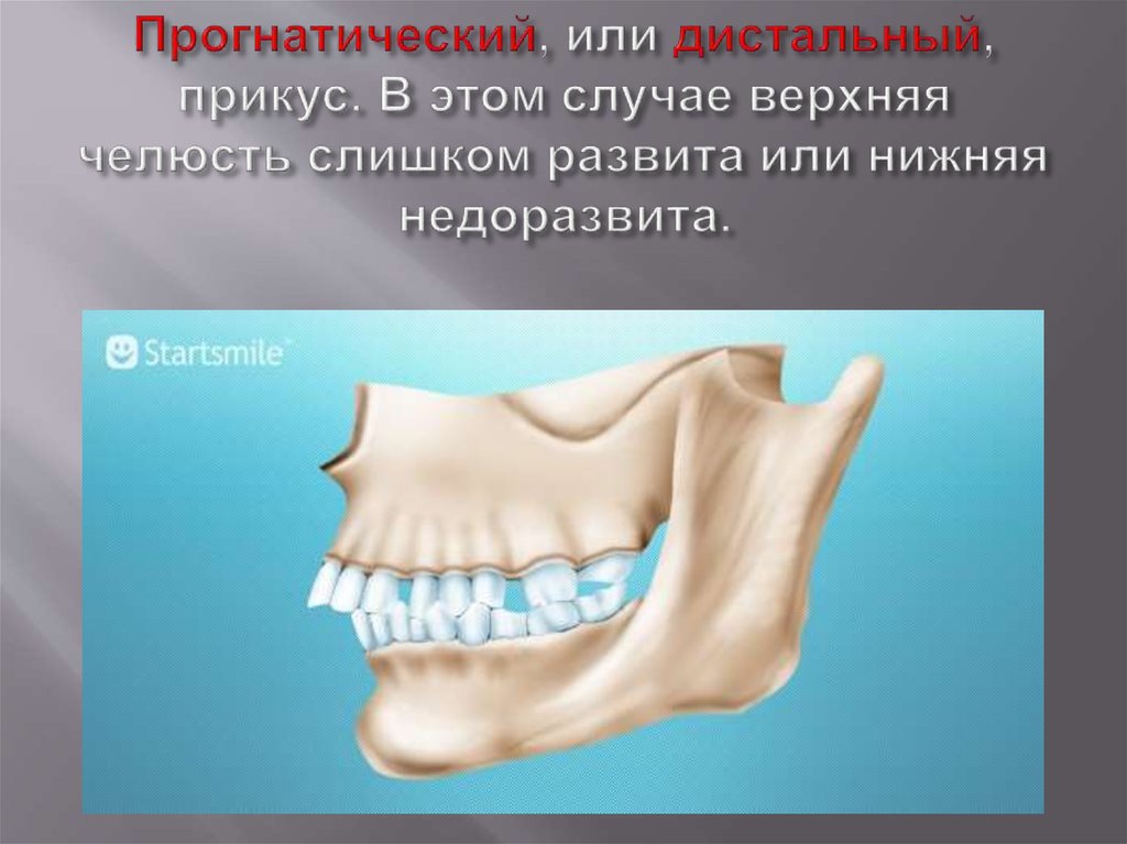 Прогения нижней челюсти