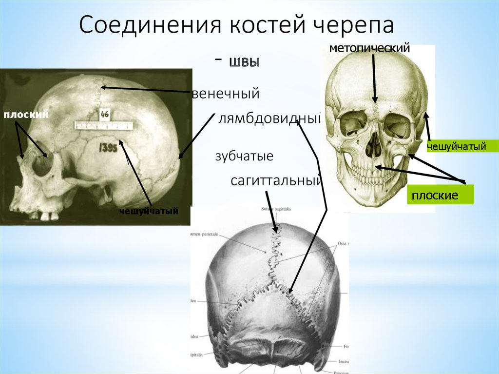 Черепно мозговую кость. Кости и швы черепа анатомия. Череп анатомия соединения костей черепа. Межкостные швы костей черепа. Швы черепа метопический шов.