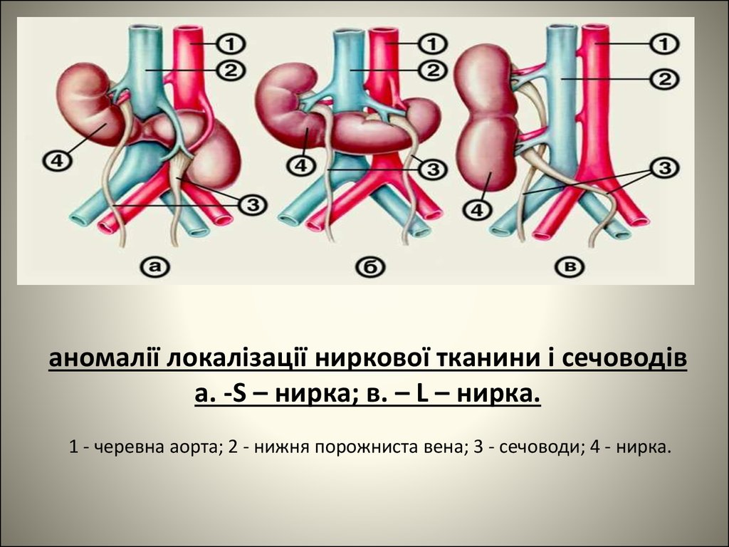 аномалії локалізації ниркової тканини і сечоводів а. -S – нирка; в. – L – нирка. 1 - черевна аорта; 2 - нижня порожниста вена; 3 - сечоводи; 4 - нирк