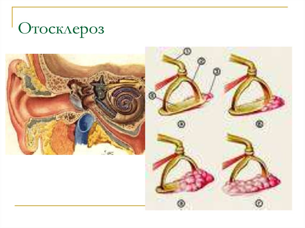 Отосклероз по утвержденным клиническим рекомендациям. Отосклероз патоморфология. Тимпанальный отосклероз. Отосклероз Вовлекающий овальное окно Необлитерирующий.