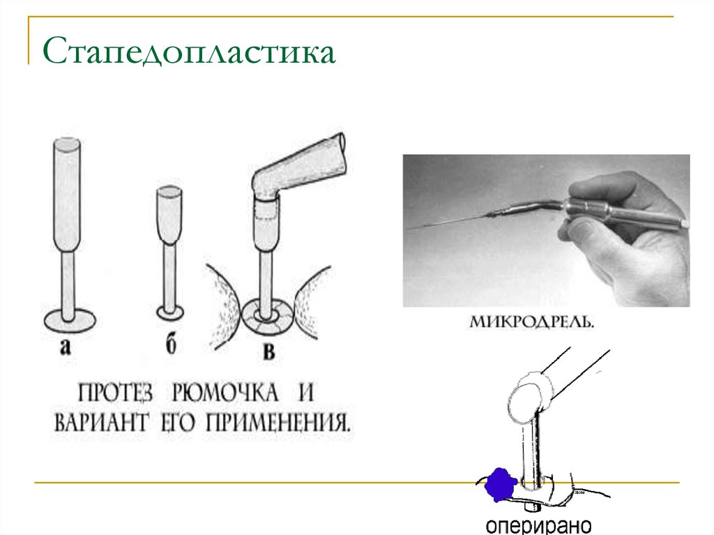 Стапедопластика. Стапедопластика поршневая методика. Стапедопластика протез. Стапедопластика титановый протез.