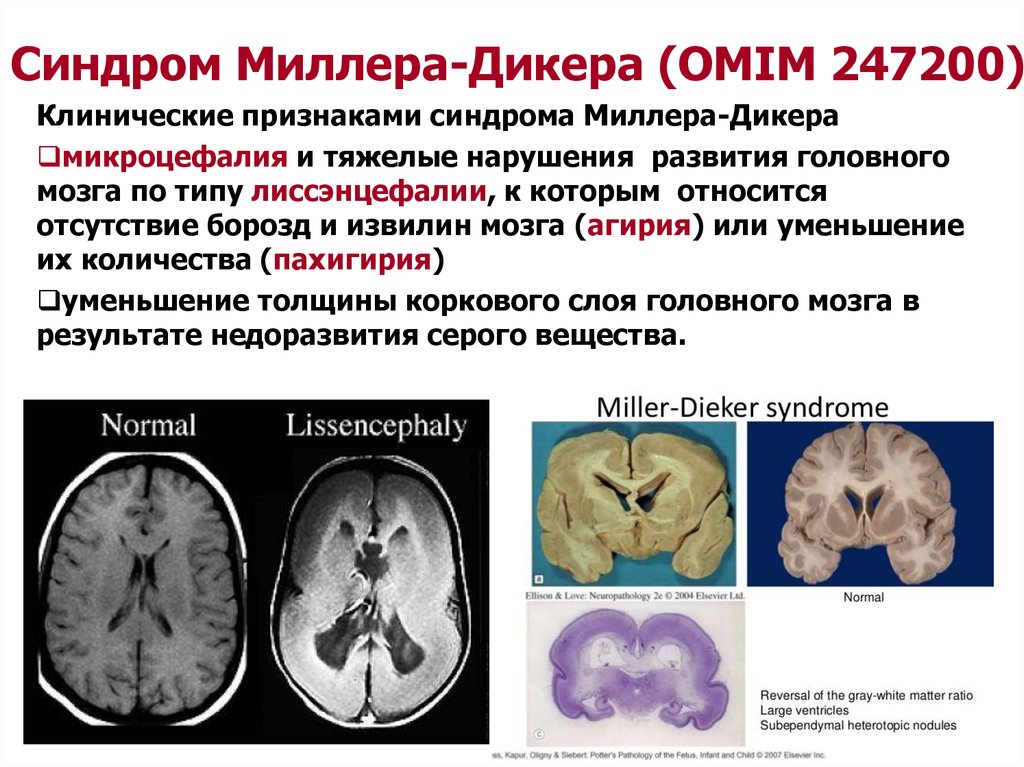 Синдром миллера дикера