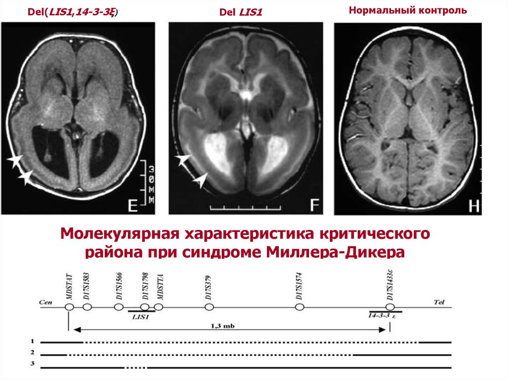 Синдром миллера дикера фото