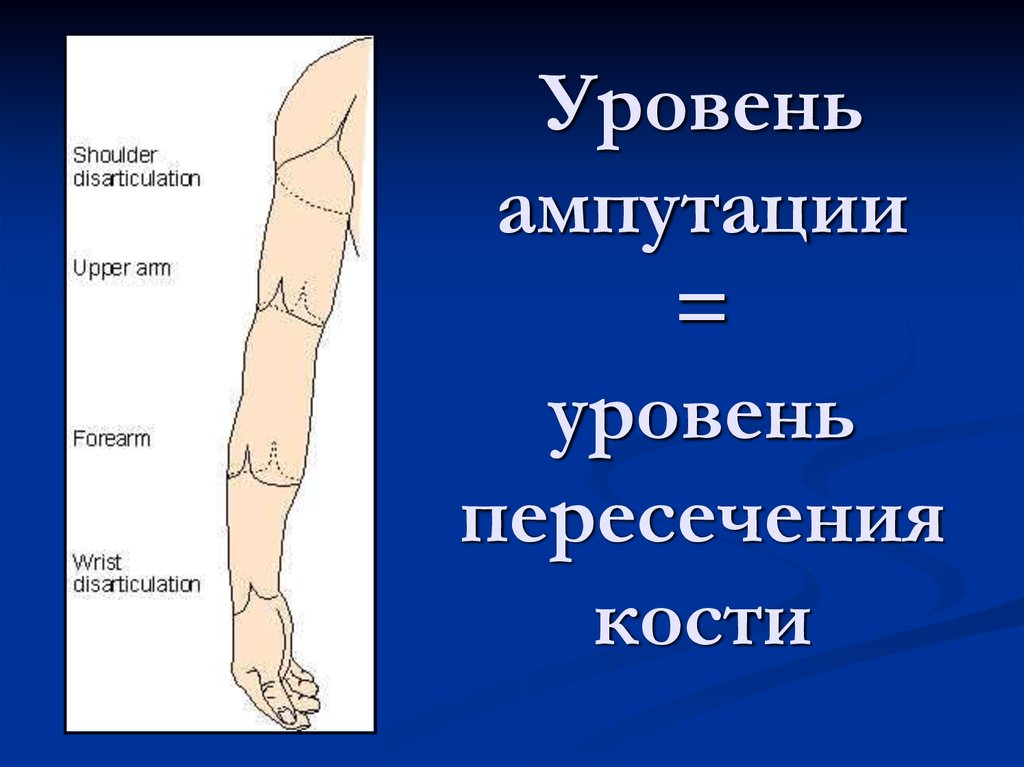 Ампутация предплечья в нижней трети. Ампутация на уровне предплечья. Как выбрать уровень ампутации. Обозначение уровней ампутации.