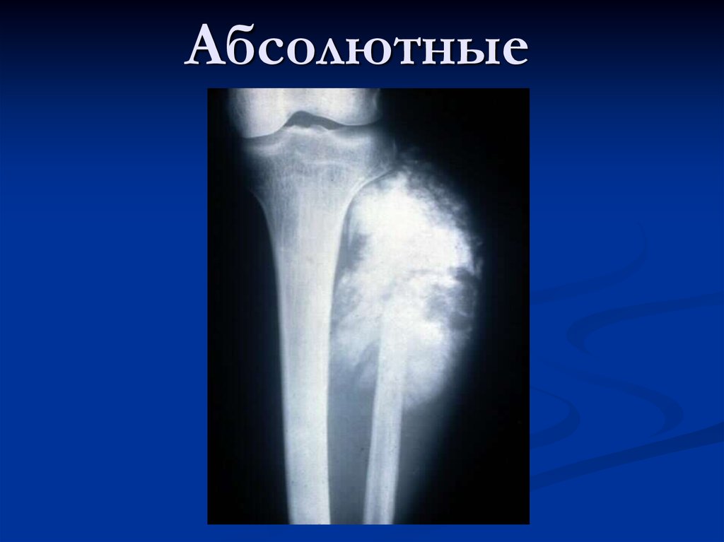Чем отличается саркома. Остеосаркома бедренной кости. Остеогенная остеолитическая саркома. Саркома Юинга симптомы кости.