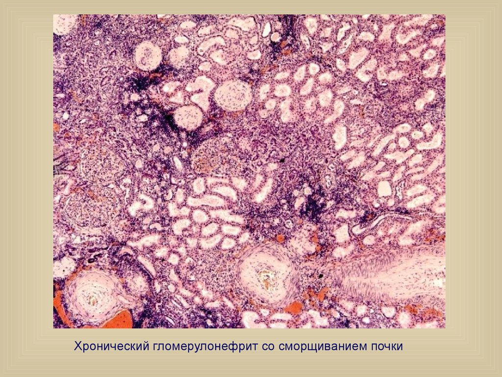 Хронический пиелонефрит микроскопическая картина