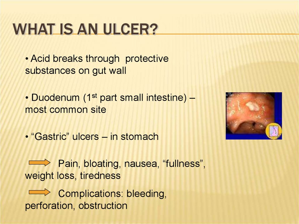 What is an ulcer?