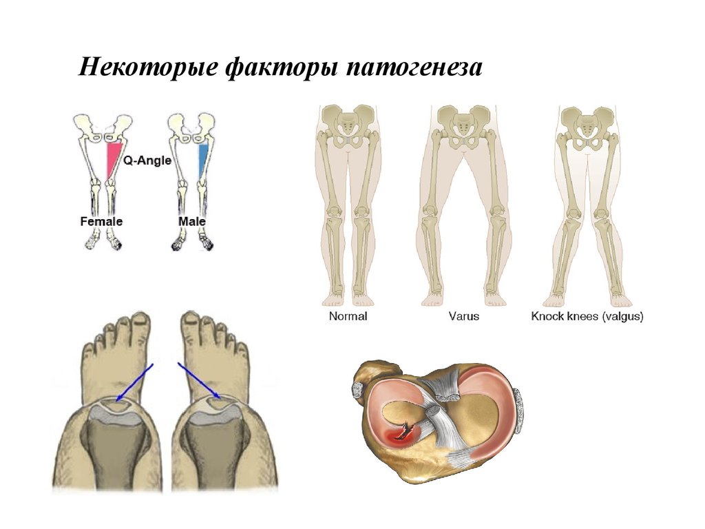 Дегенеративные заболевания суставов презентация