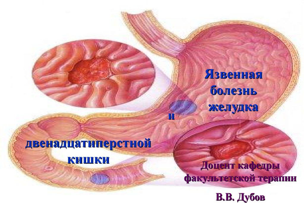 Презентация по язвенной болезни