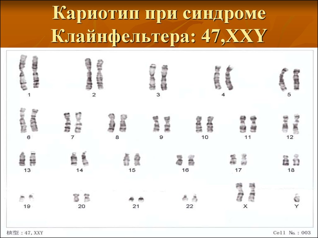 Кариотип человека определяют. Синдром Клайнфельтера кариотип. Кариограмма хромосом синдром Клайнфельтера. Синдром Клайнфельтера хромосомная формула. Хромосомная карта синдрома Клайнфельтера.