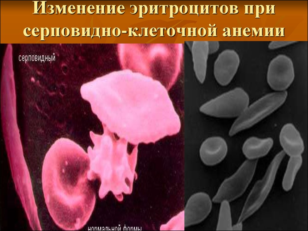 Эритроциты при серповидно клеточной анемии. Серповидноклеточная анемия. Измененные эритроциты. Эритроциты при серповидноклеточной анемии. Изменения эритроцитов при анемиях.