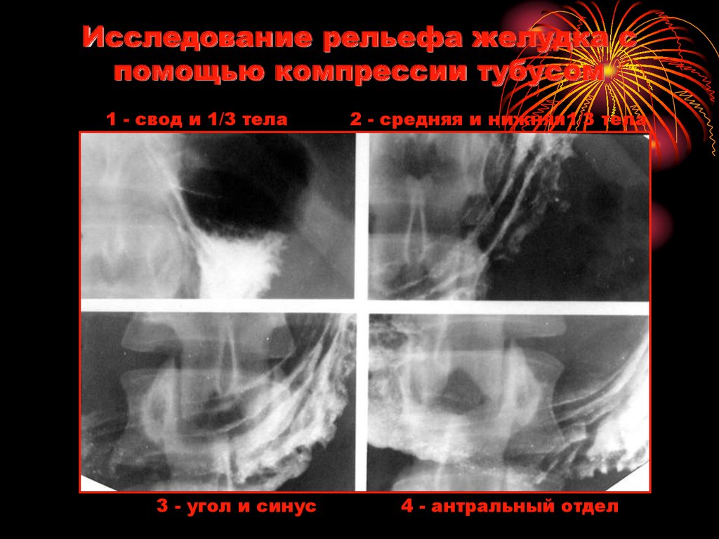 Исследование рельефа желудка с помощью компрессии тубусом
