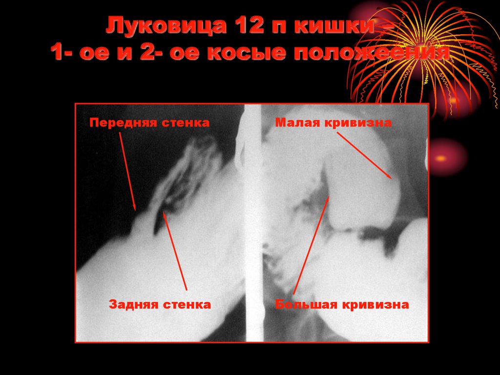 Луковица 12 п кишки – 1- ое и 2- ое косые положеения