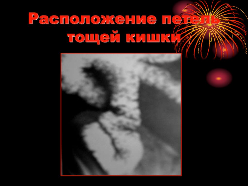 Расположение петель тощей кишки