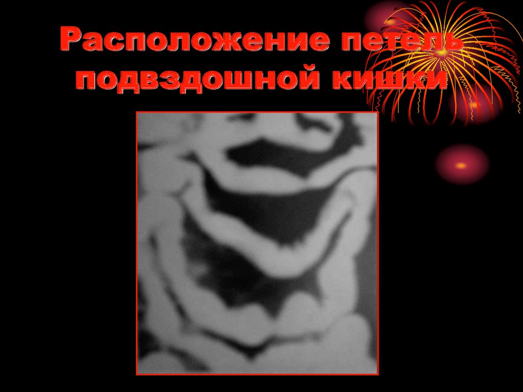 Расположение петель подвздошной кишки