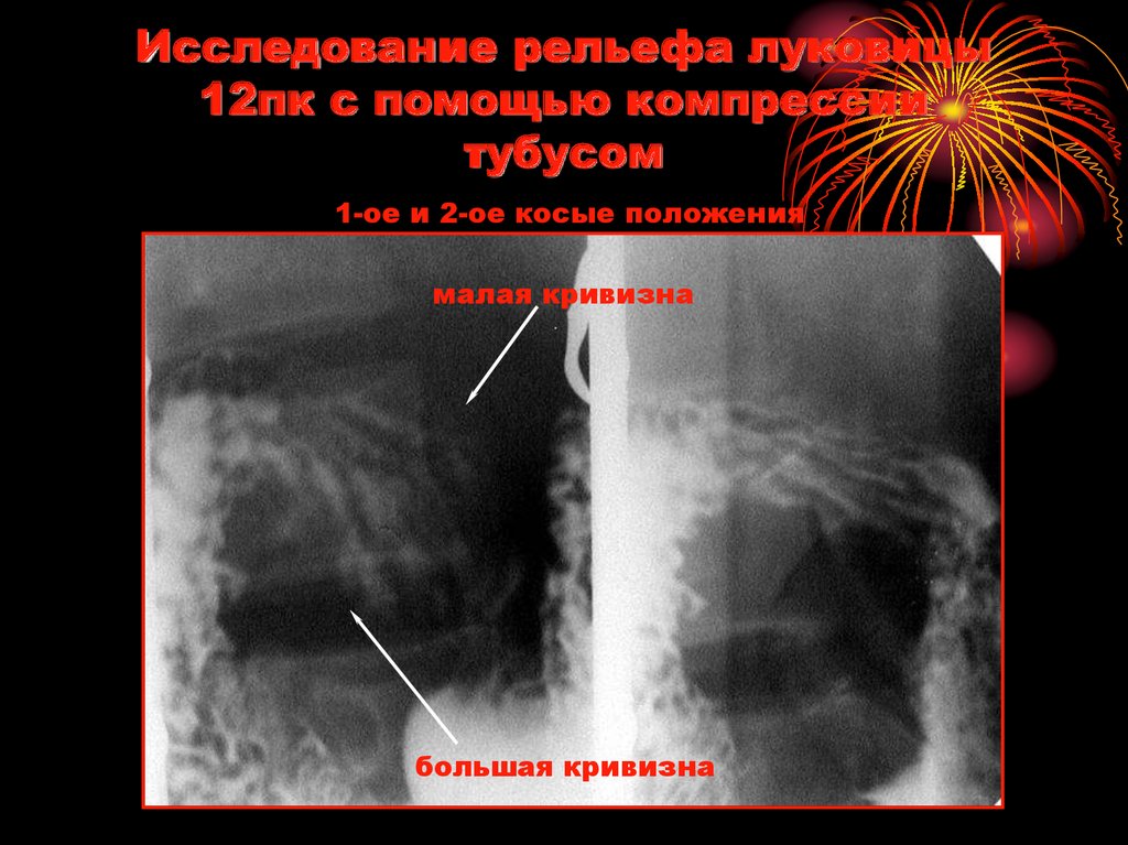 Исследование рельефа луковицы 12пк с помощью компрессии тубусом