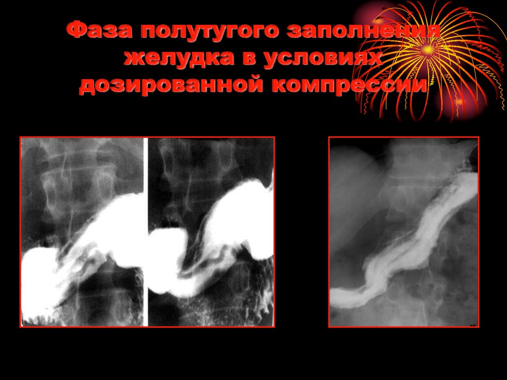 Фаза полутугого заполнения желудка в условиях дозированной компрессии