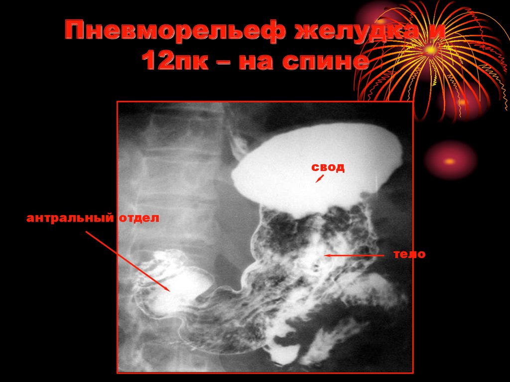 Пневморельеф желудка и 12пк – на спине
