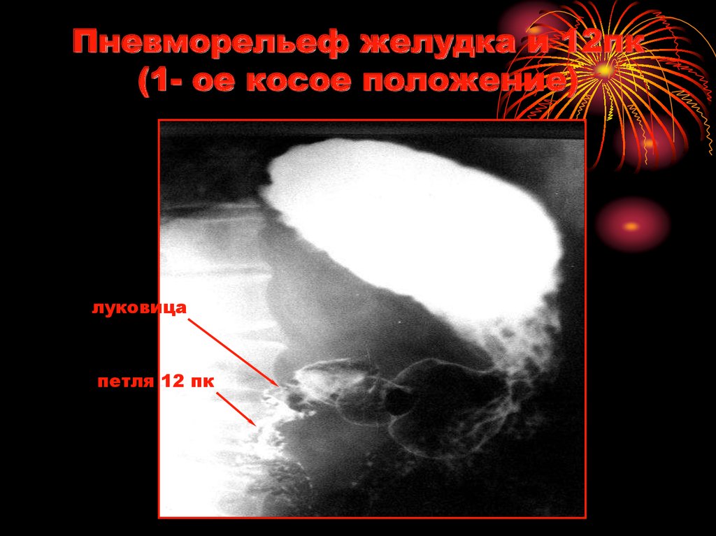 Пневморельеф желудка и 12пк (1- ое косое положение)