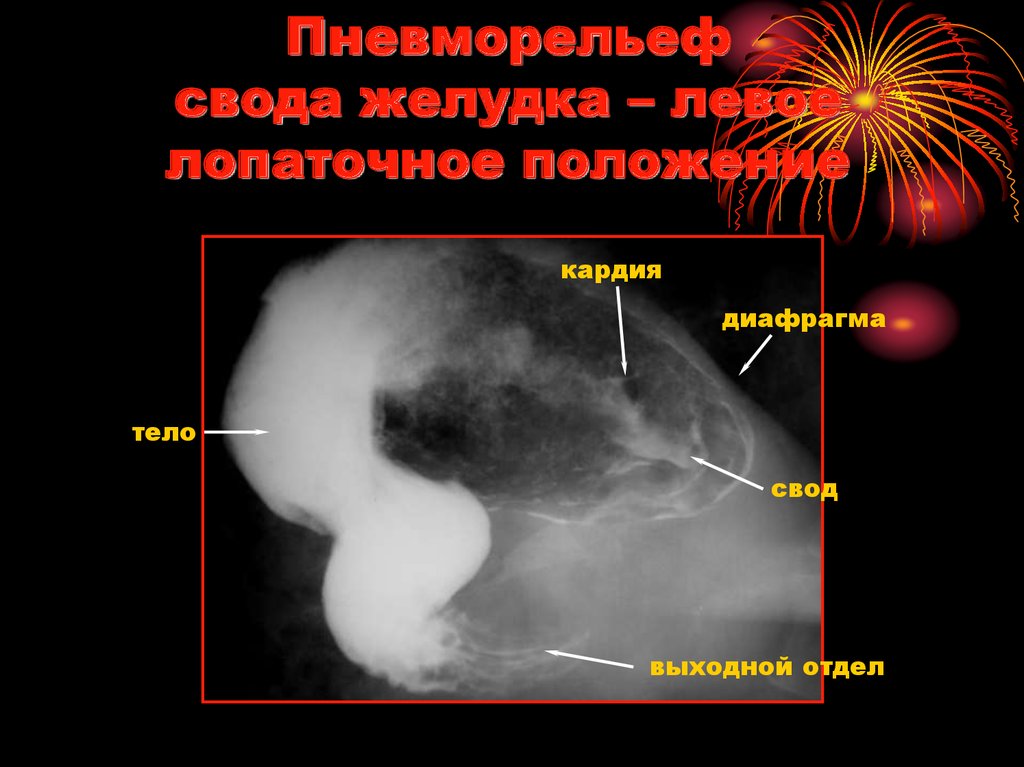 Пневморельеф свода желудка – левое лопаточное положение