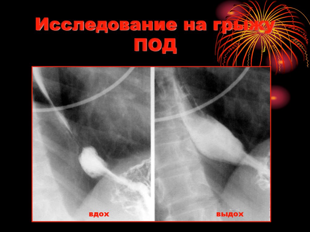 Исследование на грыжу ПОД