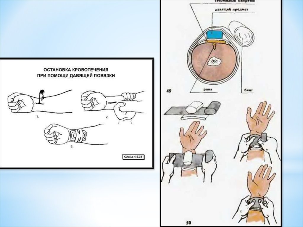 Время наложение давящей повязки. Давящая повязка алгоритм. Алгоритм давящей повязки. Техника наложения давящей повязки.