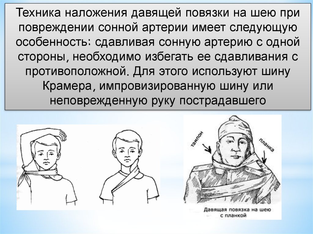 Наложение повязки на шею. При ранении сонной артерии необходимо. Давящая повязка накладывается.