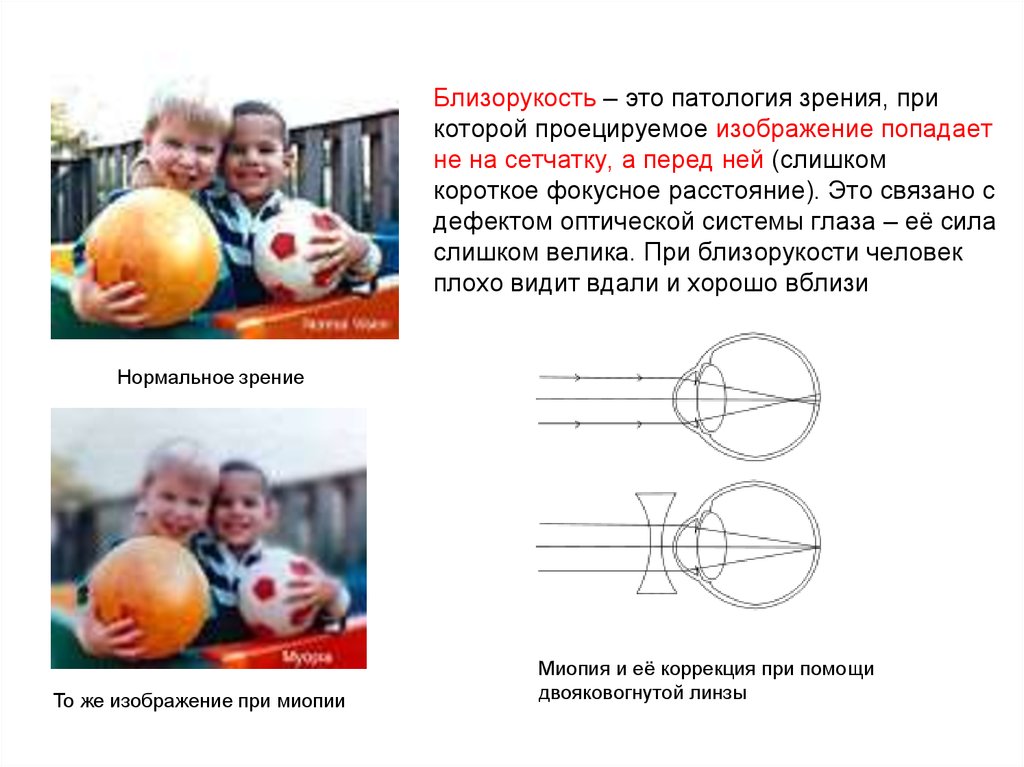 Близорукость это. Близорукость. Близорукий. Близорукость -5. Близорукость оптическая сила.