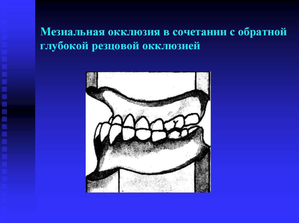 Окклюзия. Глубокая резцовая окклюзия и дизокклюзия. Трансверзальная резцовая дизокклюзия. Обратная резцовая окклюзия. Обратная резцовая дизокклюзия и окклюзия.