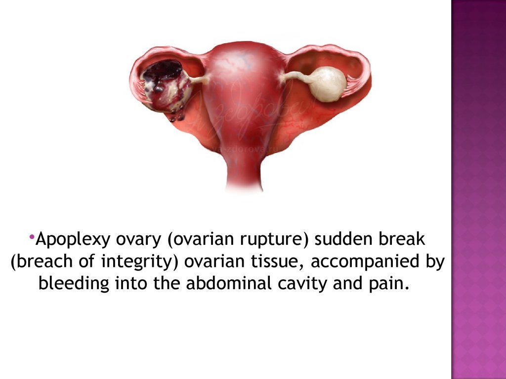 Apoplexy ovary - презентация онлайн